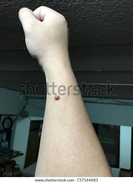 Skin Tags Arm Stock Photo 737564683 | Shutterstock