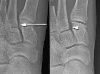 Lisfranc (Midfoot) Injury - OrthoInfo - AAOS