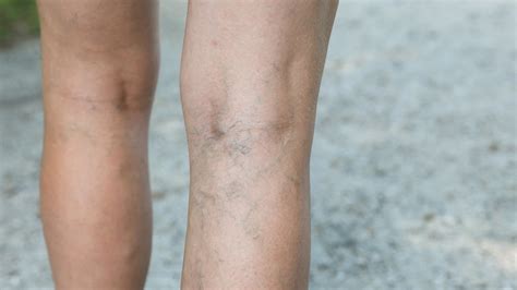 5 Key Facts about Deep Vein Thrombosis