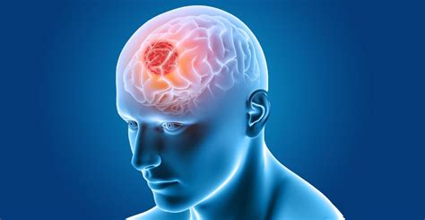 Understanding brain tumours and their risk factors