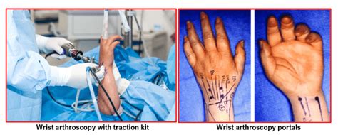 Wrist Arthroscopy – Home | Consultant Orthopaedic Surgeon