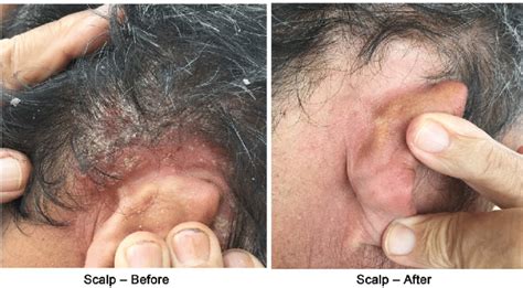 Psoriasis on the scalp before and after (4 weeks) of Psorend BEC... | Download Scientific Diagram