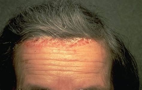 Scalp Psoriasis - Causes &Treatment Options, Natural & Home Remedies