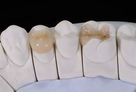 How Much Do Porcelain Veneers Cost In NYC? (Prices / Fees)