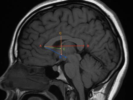 Anterior commissure – European Journal of Anatomy