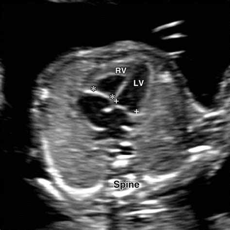 What Is Normal Fetal Cardiac Activity Means - PELAJARAN