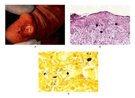 Primary Syphilis | NEJM