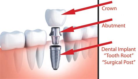 N Frisco TX, Frisco Oral And Dental Implant Surgery