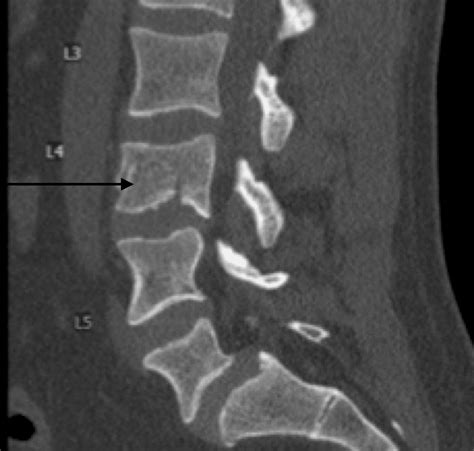 Cureus | Nonoperative Management in Intact Burst Fracture Patient With ...