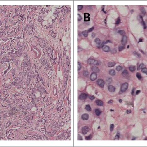 Histology of the resected mastectomy specimen ( H & E, original... | Download Scientific Diagram