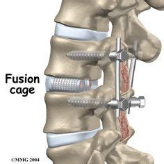 l5/s1 fusion - my lower back.... | Spine surgery, Spinal fusion surgery, Spinal fusion