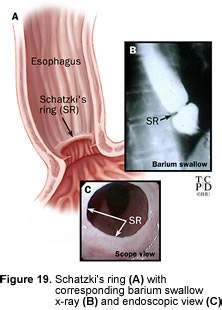 MEDICAL IMAGES: Schatzki's ring