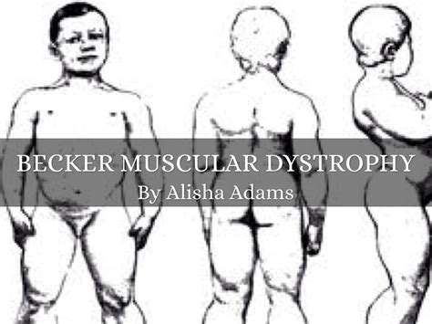 Beckers Muscular Dystrophy Archives Genetic Education | Images and ...