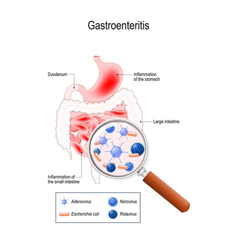 Acute Gastroenteritis Treatment | Stomach Bug Doctor