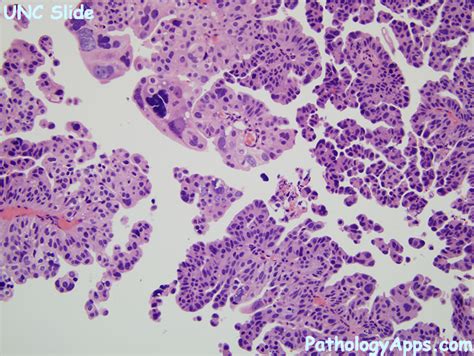 urothelial carcinoma pathology