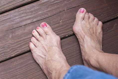 Bunions: No Fun for Your Feet | For Better | US News