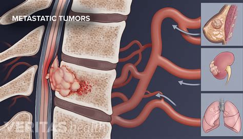 Anatomy Of A Tumor