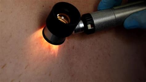 ‘It’s huge’: Vaccine for melanoma found to reduce recurrence, death by half - National ...