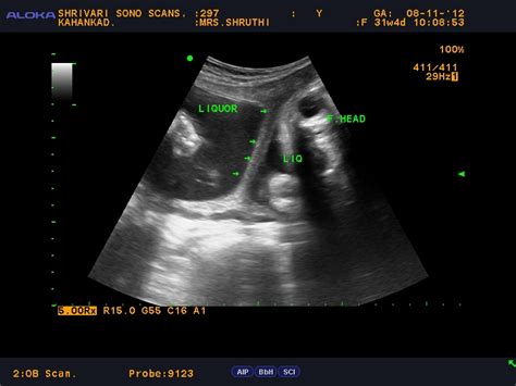 Shrivari Sono Scans: Intrauterine synechiae-Amniotic sheets visualized in the uterus