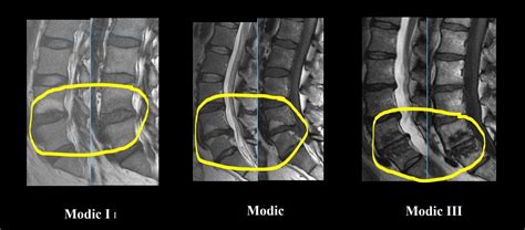 Modic Change and Chronic Pain — Functional Pain Relief