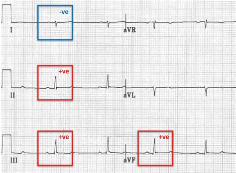 Right Axis Deviation (RAD) • LITFL • ECG Library Diagnosis