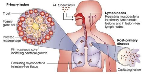 Streptococcus Pneumonia :Clinical Manifestations , Diagnosis and treatment - www.medicoapps.org