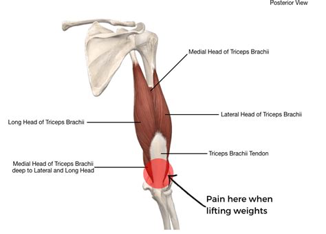 Triceps Tendonitis Lifters Elbow Pain (A Helpful Guide) | atelier-yuwa ...