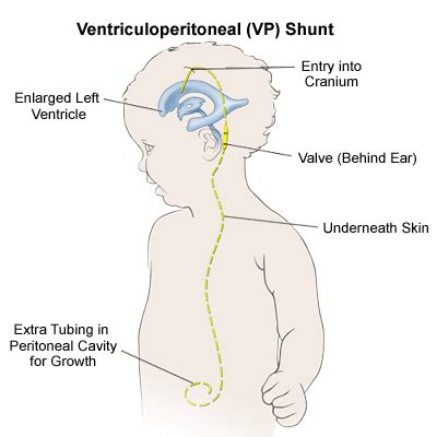 The Project | BENG 492 Group 2: Ventriculoperitoneal Shunts