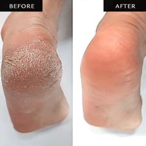 Best Foot Callus Removal Singapore | NING Spa Jewel Changi