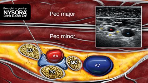 Tips for an Infraclavicular Brachial Plexus Block - NYSORA