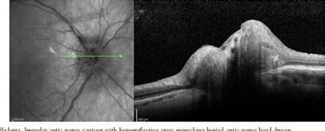 Figure 1 from Differentiating mild papilledema and buried optic nerve head drusen using spectral ...