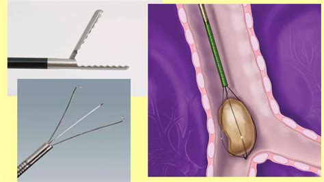 Tracheobronchial tree anatomy and bronchoscopy | PPT