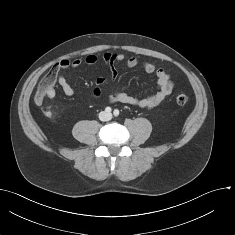 Appendicitis Ct Radiopaedia It is a very common condition in general radiology practice and is ...