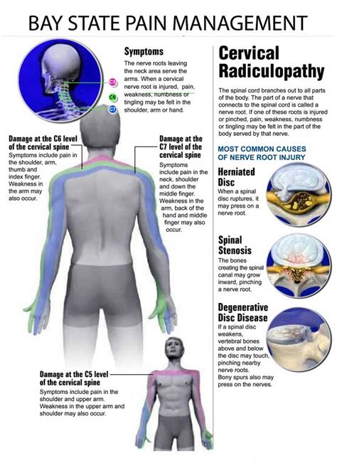 cervical radiculopathy treatment pdf - Stepanie Givens