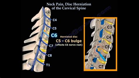 C5 And C6 Herniated Disc Treatment - tiktoktoktok