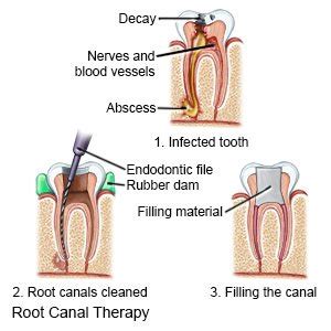 Root Canal - What You Need to Know