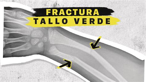 Fracturas en tallo verde en niños - Dr Gallego - Traumatología Deportiva y Cirugía Ortopédica