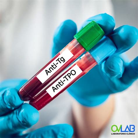 ANTICUERPO ANTITIROIDES (ANTI TPO / ANTI TG) – O&V Laboratorios