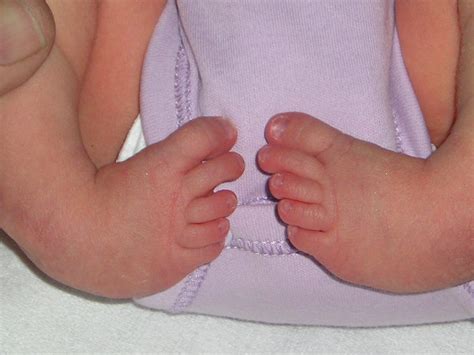 Talipes equinovarus - Types, Symptoms, Causes and Treatment