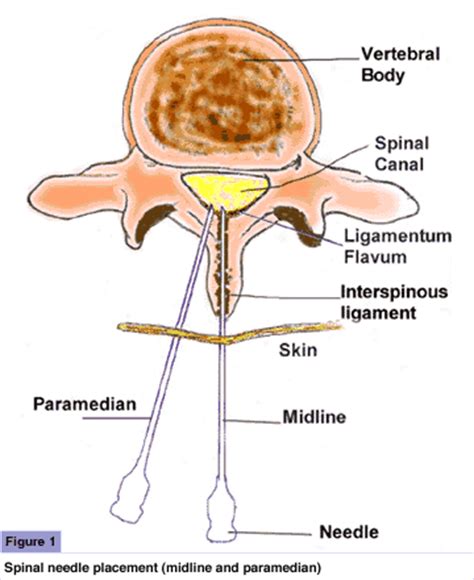 Spinal block - Pain - MedBroadcast.com