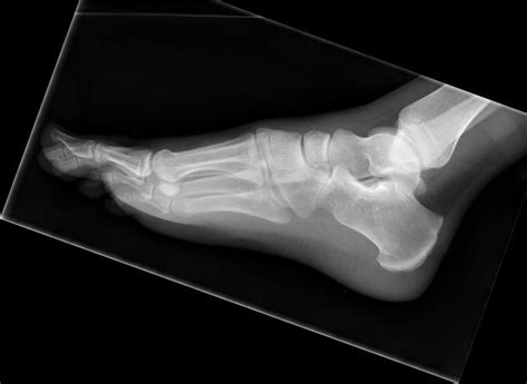 Navicular fracture | Radiology Reference Article | Radiopaedia.org | Radiology, Fracture ...