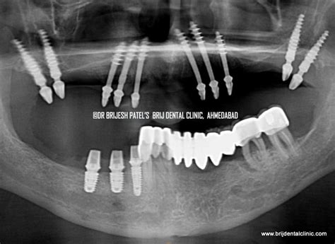 Immediate loading Basal Implants Ahmedabad India| No teeth to fix teeth in 3days