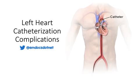 emDOCs.net – Emergency Medicine EducationLeft Heart Catheterization ...