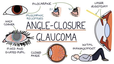 Understanding Acute Angle Closure Glaucoma - vTomb