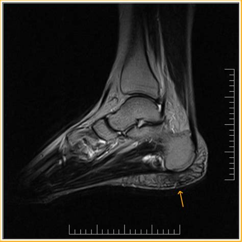 Heel Fat Pad Syndrome - Sumer's Radiology Blog