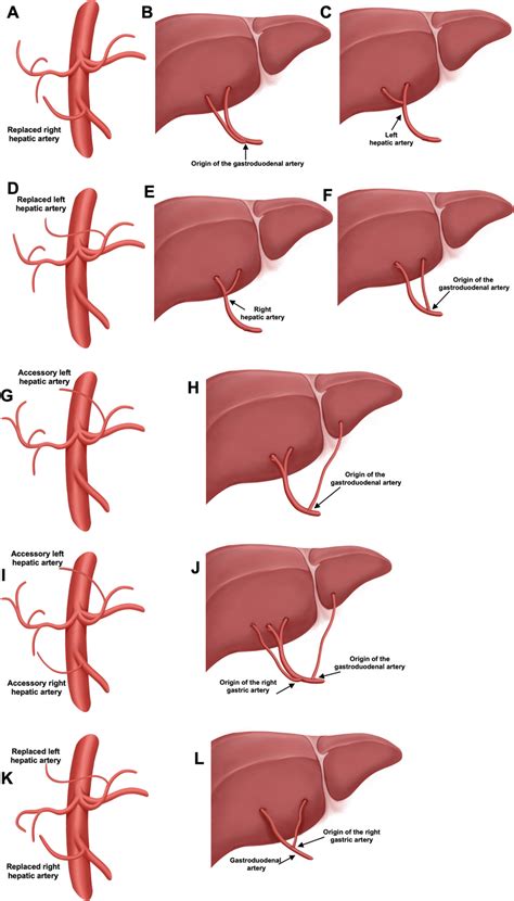 Variations of the hepatic artery and reconstruction. Nine liver grafts... | Download Scientific ...