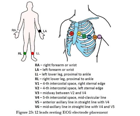 23+ 12 Lead Ecg Placement Pdf - JeffreyKeison