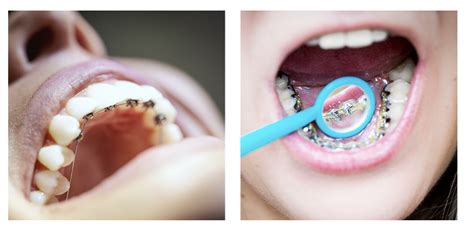 What Are Lingual Braces? (A Complete Guide) - Tisseront Orthodontics