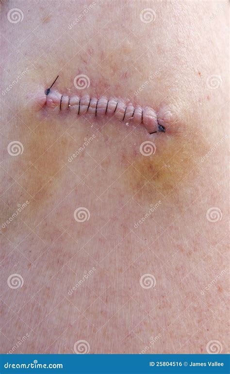 Stitches after Skin Cancer Removal Stock Photo - Image of close, cancer ...