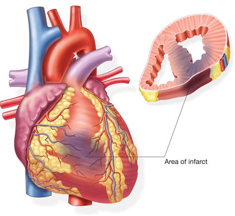 Heart Attack | Valentino Cardiology Specialists